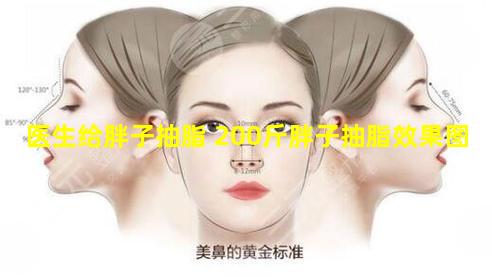 医生给胖子抽脂 200斤胖子抽脂效果图